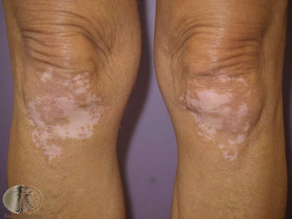 Diagnose This Lesions